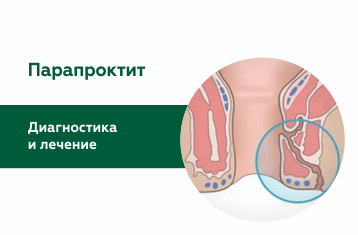 Лечение парапроктита